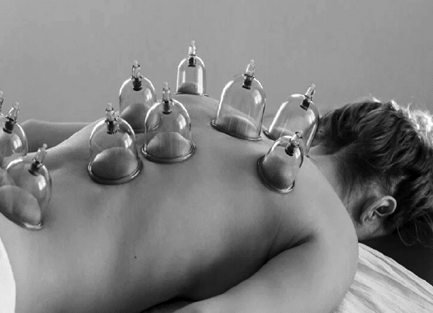 leaderjudgement ಚಿಕಿತ್ಸೆ -ಆರೋಗ್ಯ – ಏನಿದು? ಕಪ್ಪಿಂಗ್ ಥೆರಪಿ