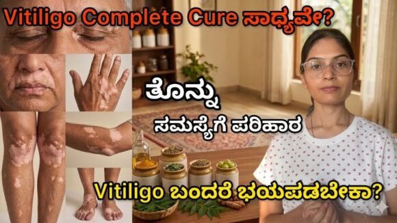 ಚರ್ಮದ ಮೇಲೆ ಸಣ್ಣ ಬಿಳಿ ಕಲೆ ಅಥವಾ White patches ಕಾಣಿಸಿಕೊಂಡಿದೆಯಾ? Ignore ಮಾಡ್ಬೇಡಿ | Vitiligo /ತೊನ್ನು