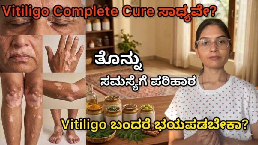ಚರ್ಮದ ಮೇಲೆ ಸಣ್ಣ ಬಿಳಿ ಕಲೆ ಅಥವಾ White patches ಕಾಣಿಸಿಕೊಂಡಿದೆಯಾ? Ignore ಮಾಡ್ಬೇಡಿ | Vitiligo /ತೊನ್ನು